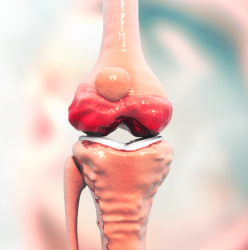 TRATAMENTO E PREVENÇÃO DA OSTEOARTRITE